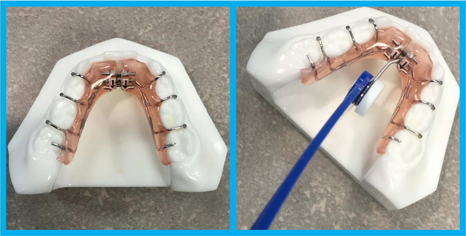 Schwartz Lower Expander Instructions at Smile Appeal Orthodontics