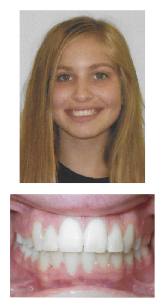Ann - After Orthodontic Treatment