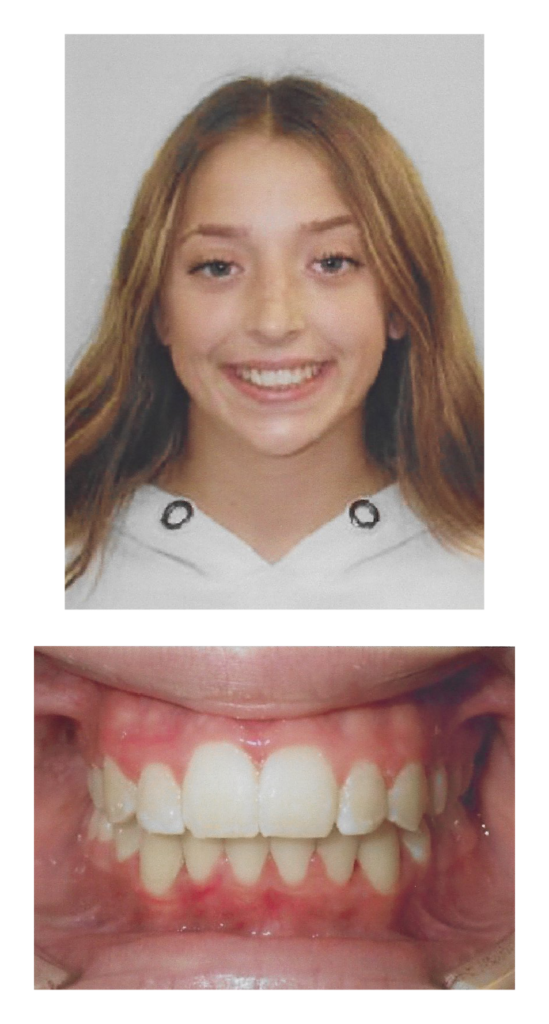 Ava - After Orthodontic Treatment