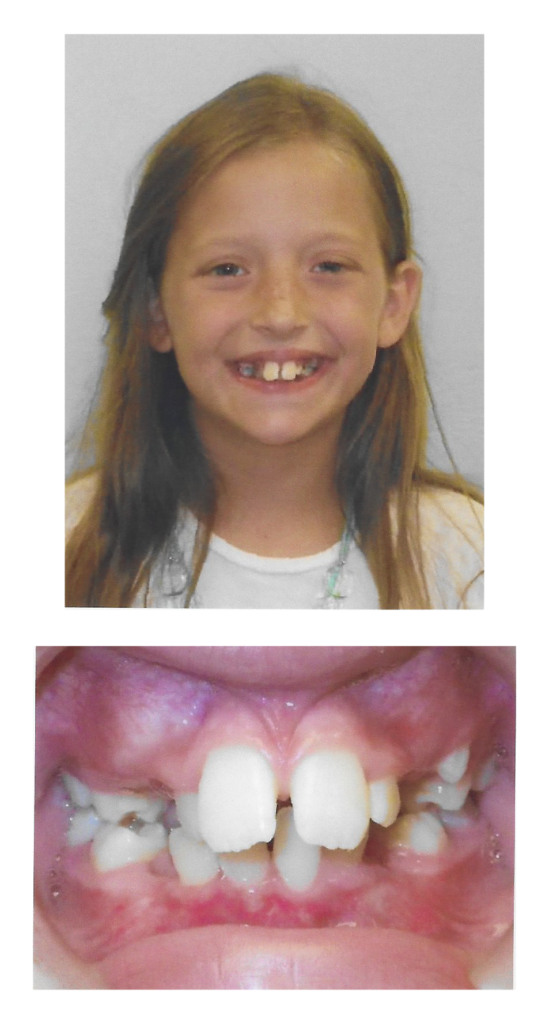 Ava - Before Orthodontic Treatment