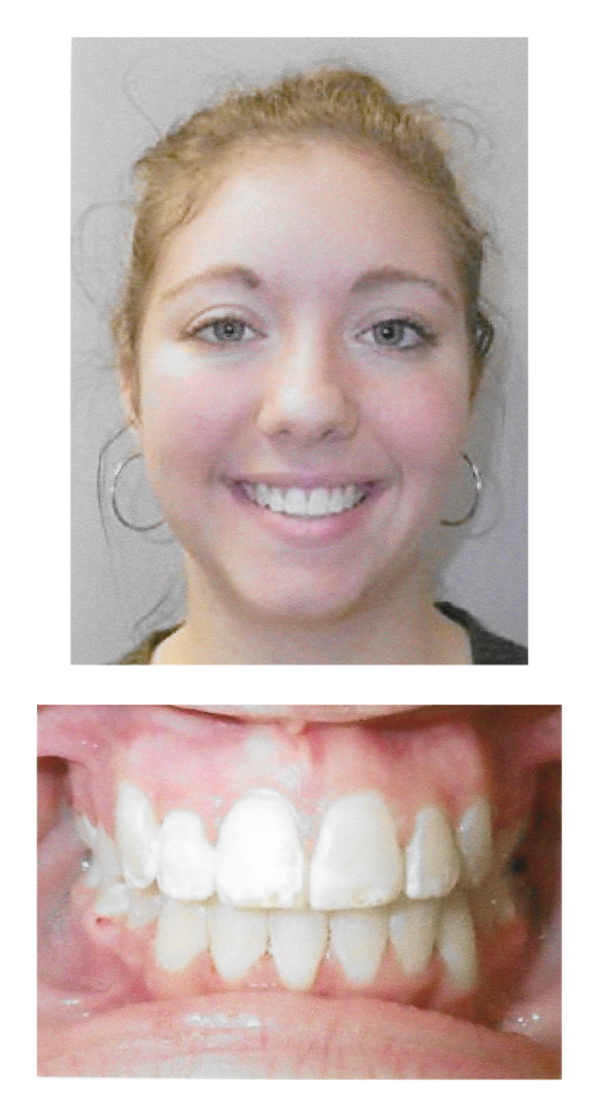 Emily - After Orthodontic Treatment