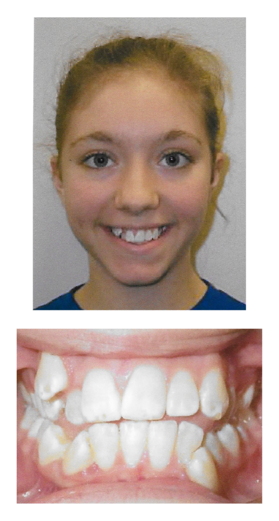 Cary - Before Orthodontic Treatment