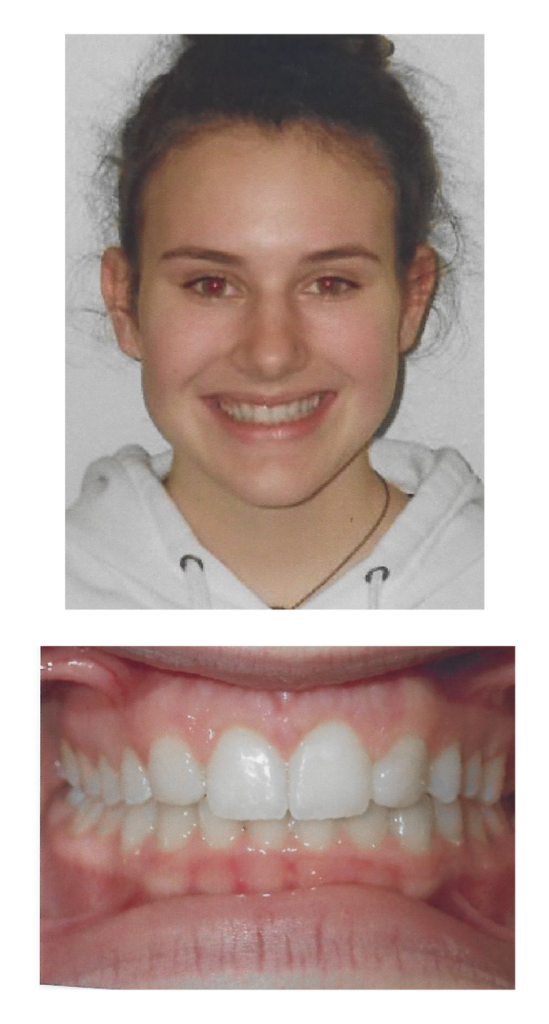 Emily - After Orthodontic Treatment