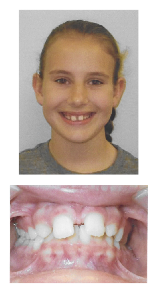Emily - Before Orthodontic Treatment