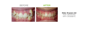Before and After, Male Fixed Braces Patient