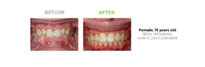 Before and After, Female Fixed Braces Patient