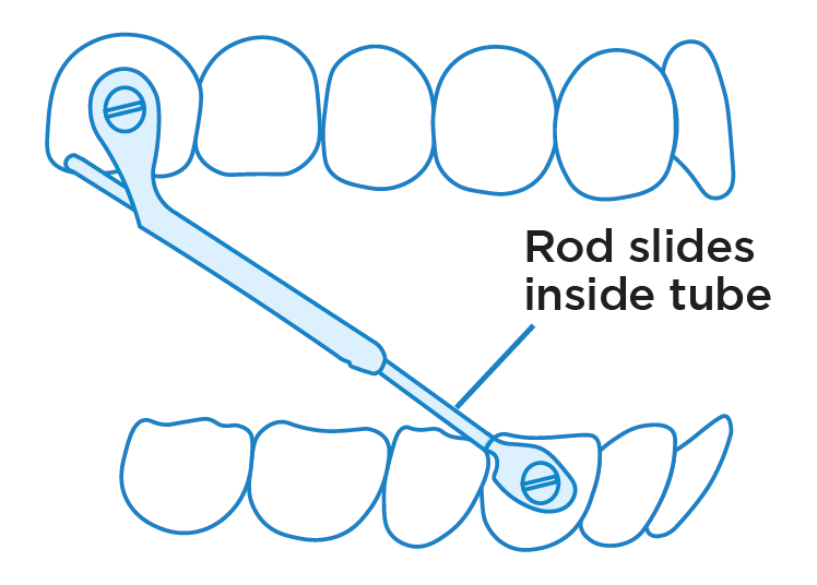 Herbst® Appliance Instructions at Smile Appeal Orthodontics