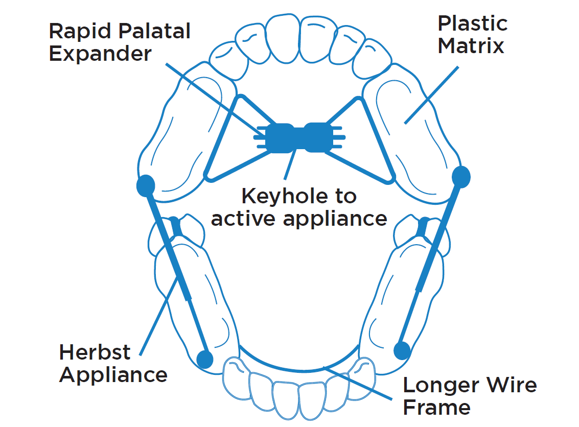 Herbst® Appliance Instructions at Smile Appeal Orthodontics