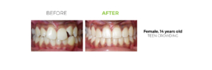 Before and After, Teen Invisalign Patient