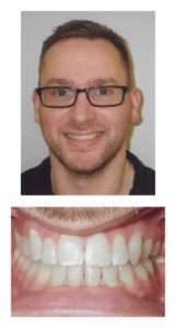 Joshua - AFter Orthodontic Treatment