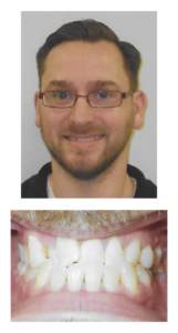 Joshua - Before Orthodontic Treatment