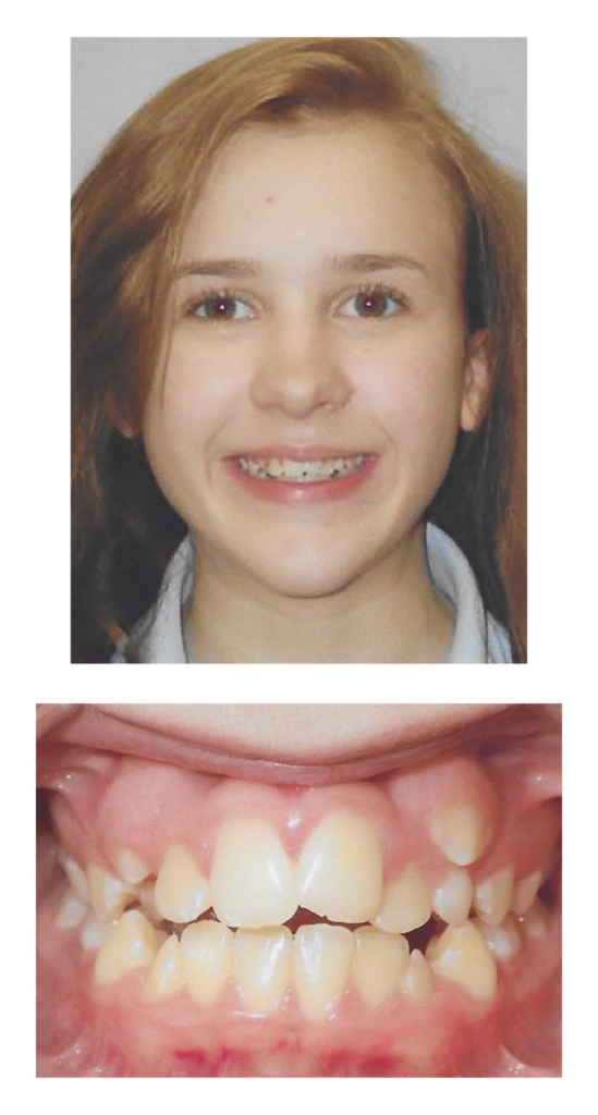 Madelyn- Before Orthodontic Treatment