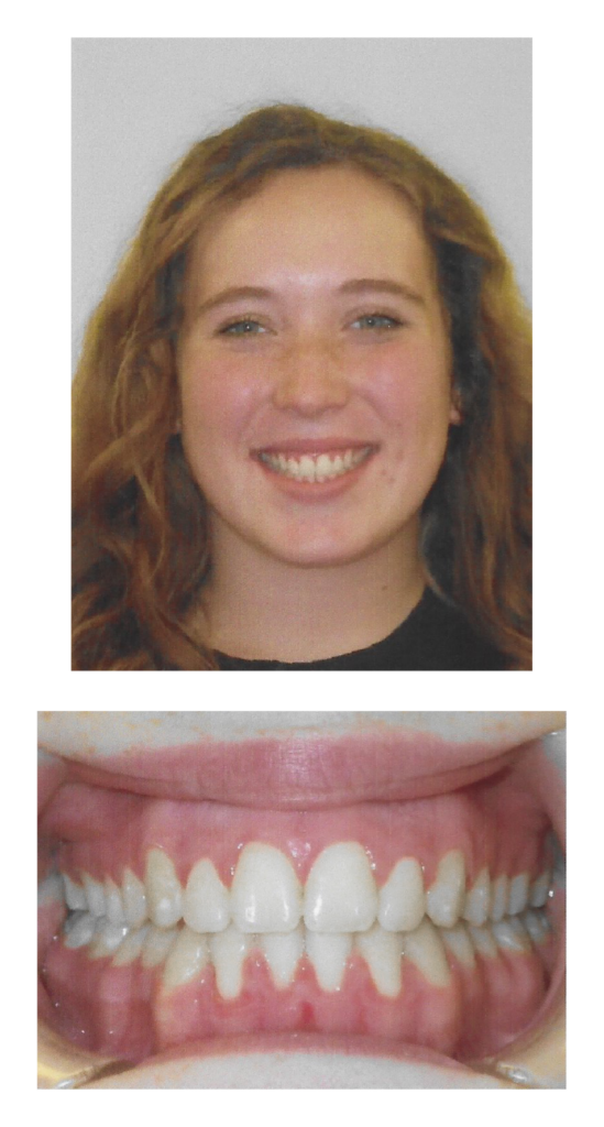 Morgan - After Orthodontic Treatment