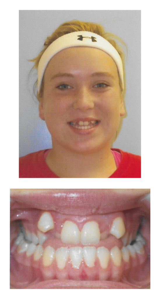 Morgan - Before Orthodontic Treatment