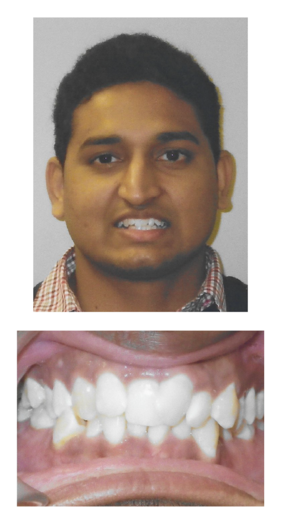 Sai - Before Orthodontic Treatment