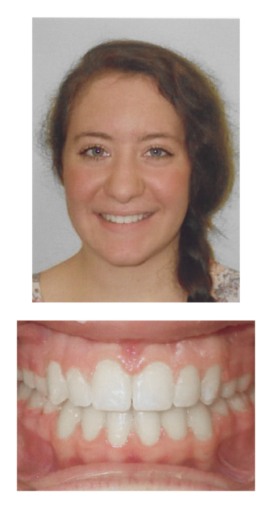 Sandra - After Orthodontic Treatment