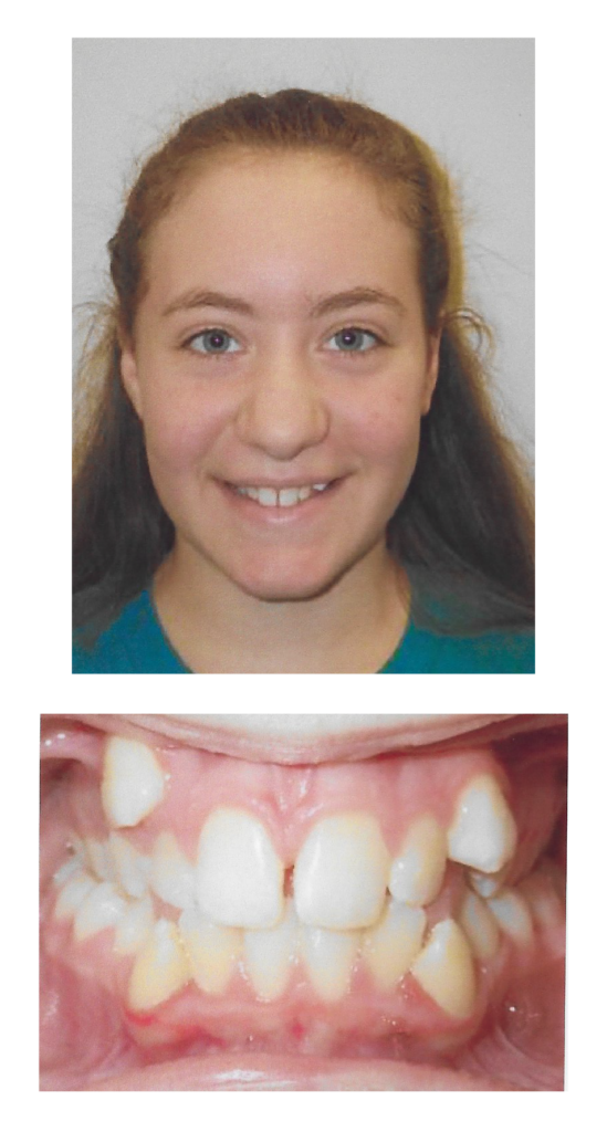 Sandra - Before Orthodontic Treatment