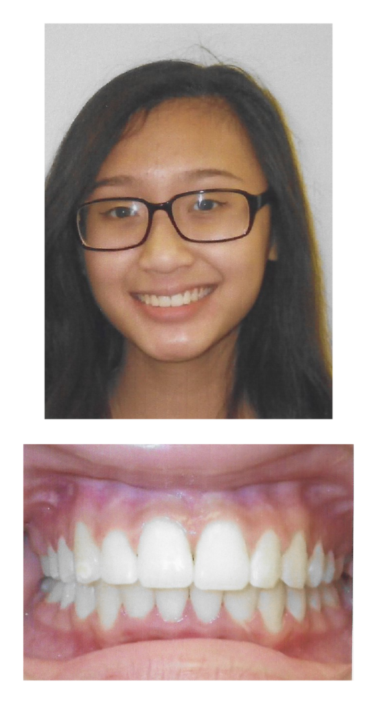 Tammy - After Orthodontic Treatment