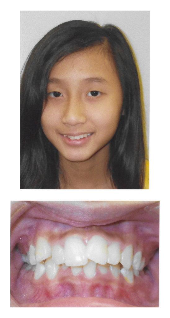 Tammy - Before Orthodontic Treatment